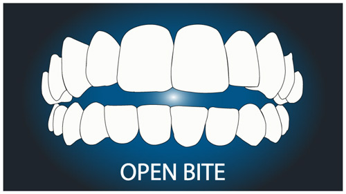 Invisalign can treat a huge range of straightening requirements