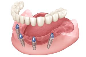 Dental Emergency Sydney