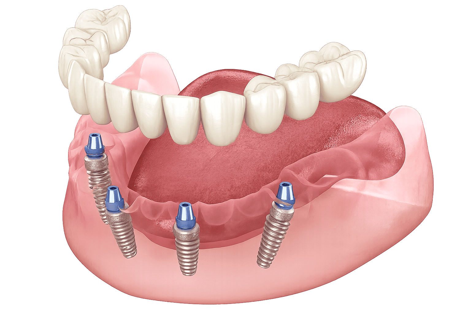 Porcelain Veneers Sydney