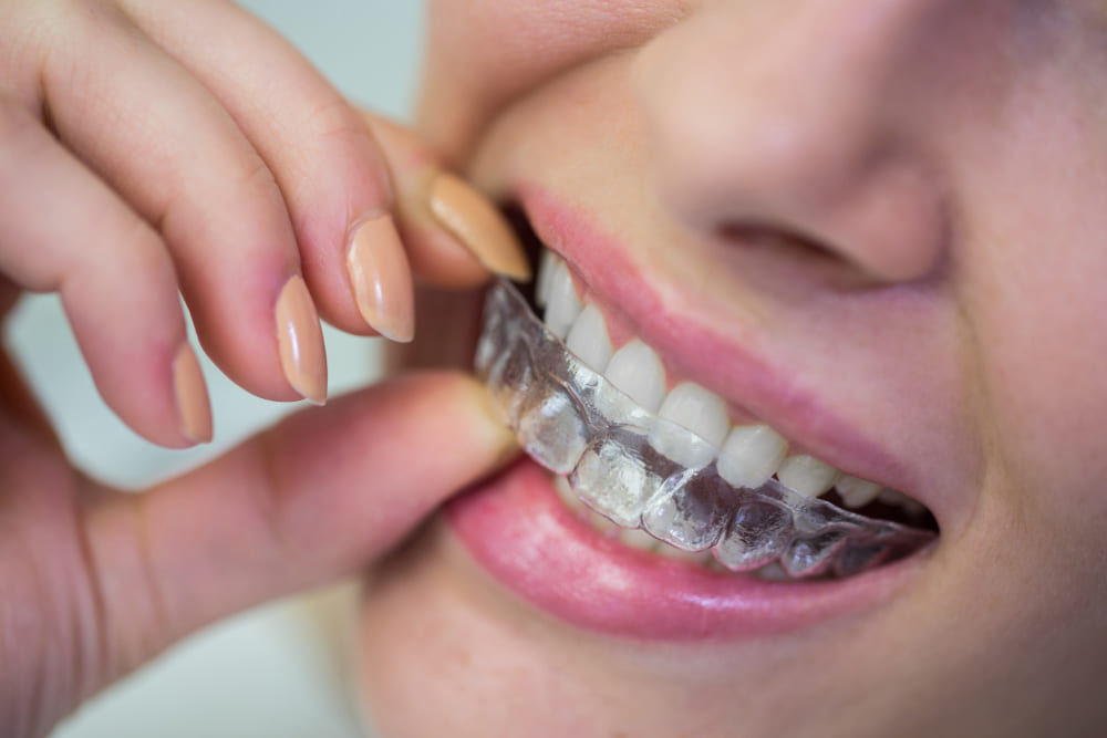 Porcelain Veneers Sydney