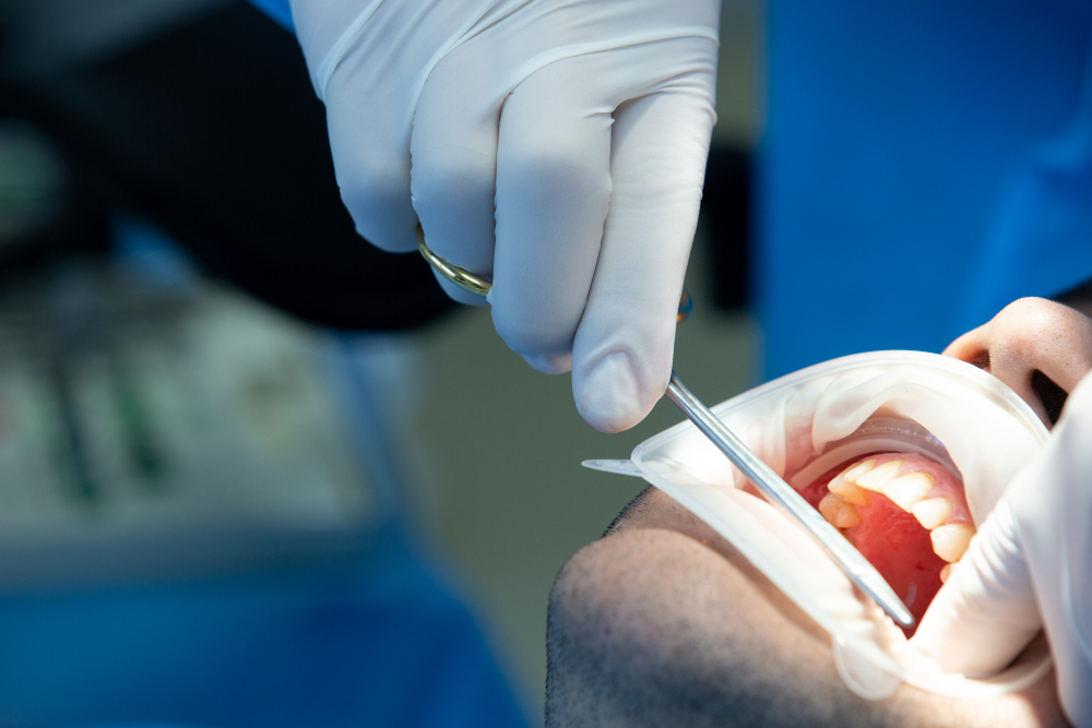 Porcelain Veneers Sydney
