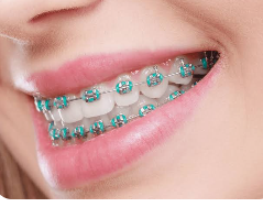 Dental Braces Sydney