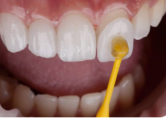 Porcelain Veneers Sydney