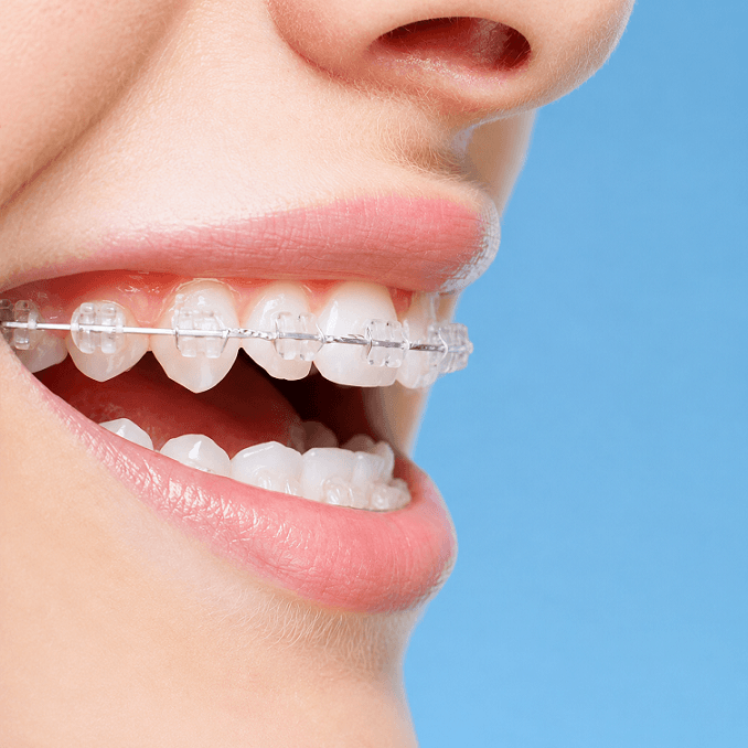Ceramic Braces Sydney