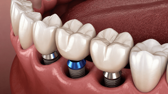 Our Difference in Dental Implant Care