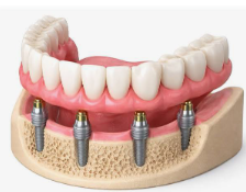 All on 4 Dental Implants Sydney