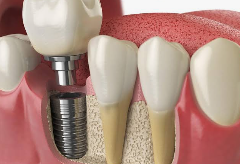 Dental Implants Sydney