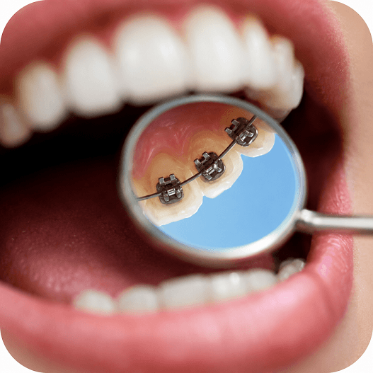 Lingual Braces Sydney