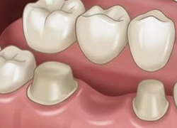 Dental Crown & Bridge Sydney