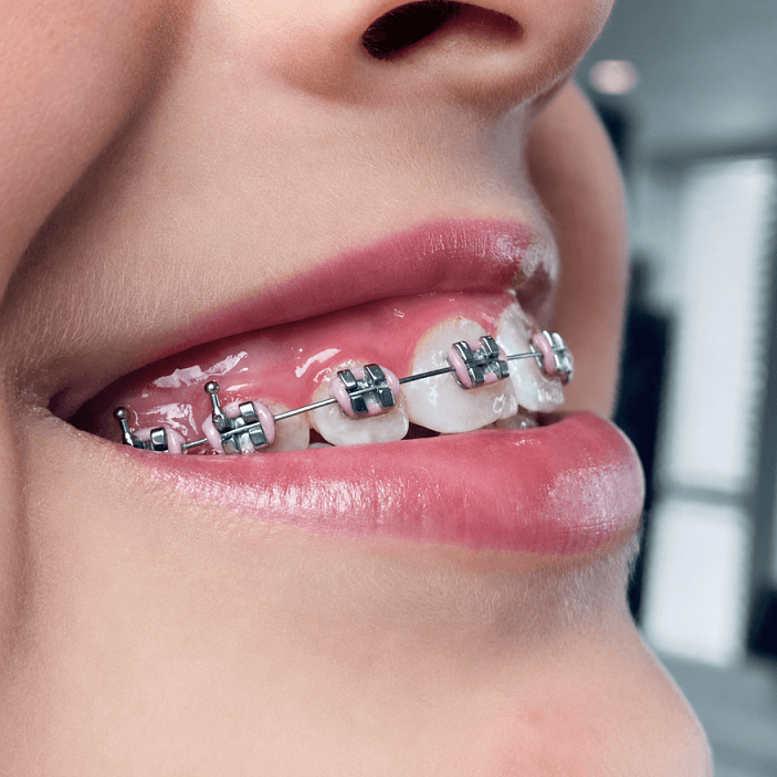 Traditional Metal Braces Sydney