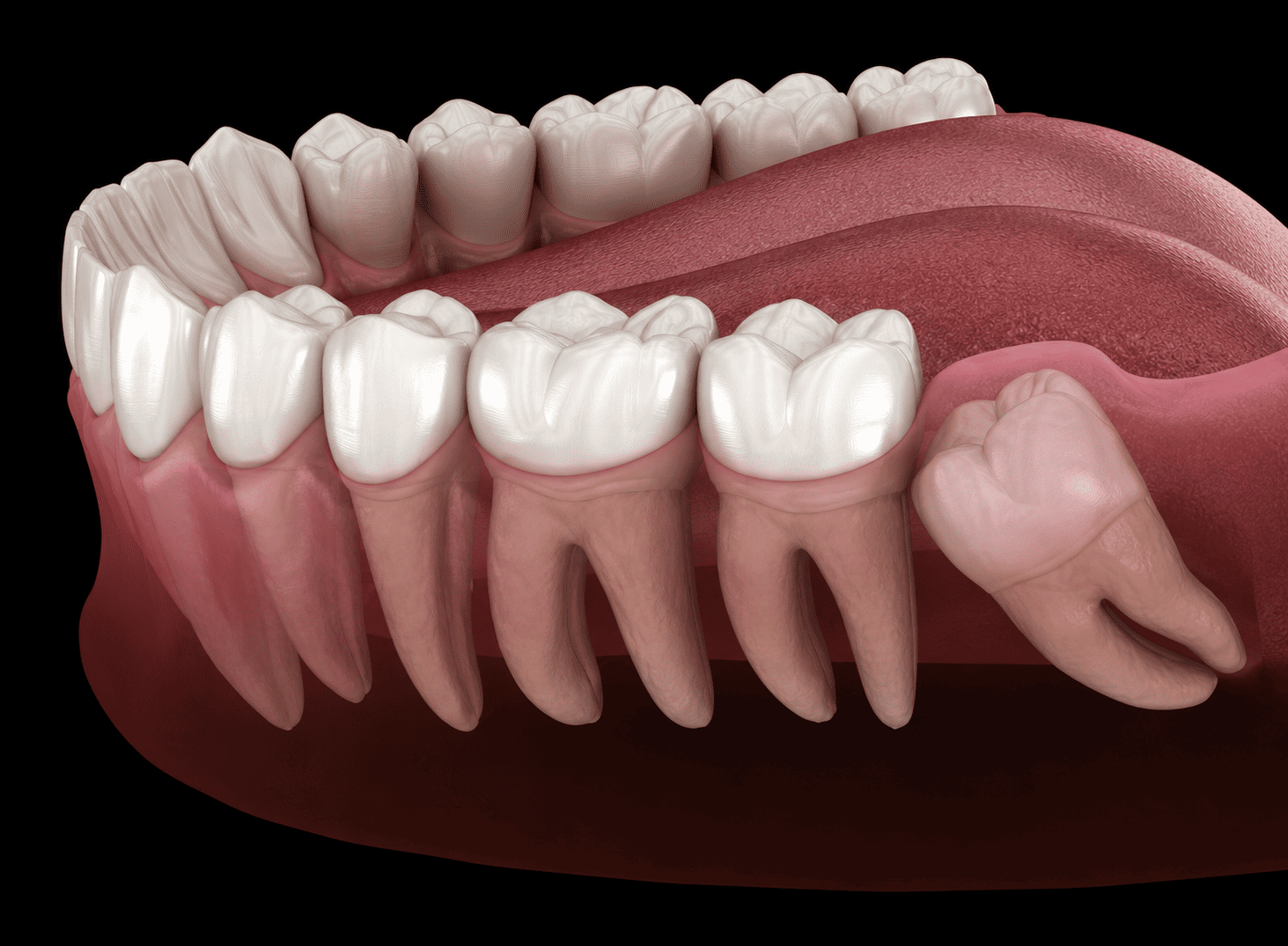 Porcelain Veneers Sydney