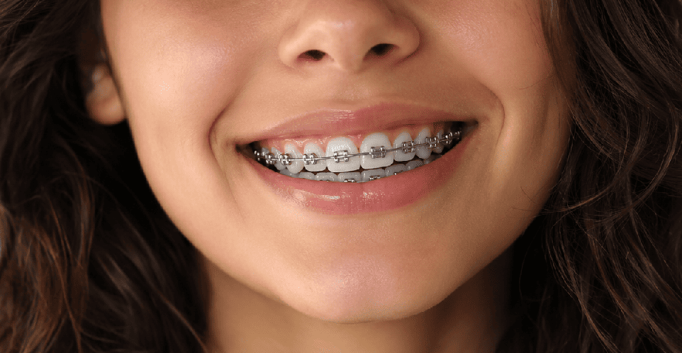 Porcelain Veneers Sydney